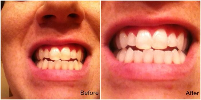 Smile Brilliant with Smile Brilliant | Mini Van Dreams #review #prfriendly #productreview